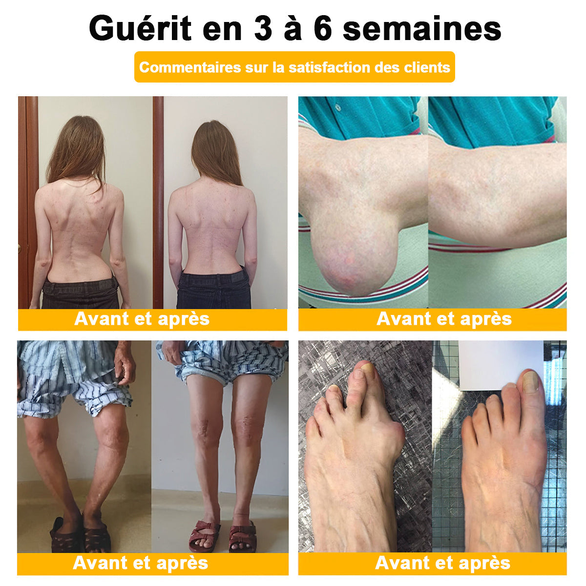 ADNOON®  Crème de guérison des os et de soulagement de la douleur au Botox et venin d'abeille