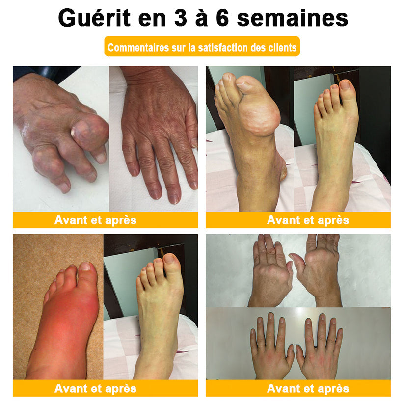 ADNOON®  Crème de guérison des os et de soulagement de la douleur au Botox et venin d'abeille