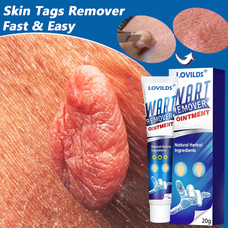 [🏆Official Flagship Store] 🔥LOVILDS® Wart remover ointment（👩‍⚕️AAD Doctor's Recommendation）