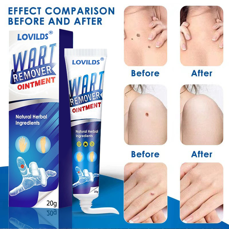 [🏆Official Flagship Store] 🔥LOVILDS® Wart remover ointment（👩‍⚕️AAD Doctor's Recommendation）