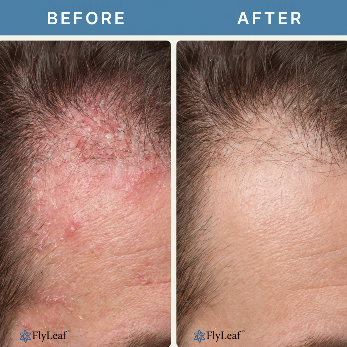 Soothing Scalp and Beard Irritation Relief Cream - Steroid-Free Skin Treatment for Redness and Flaking - Dermatology-Inspired Care for Men