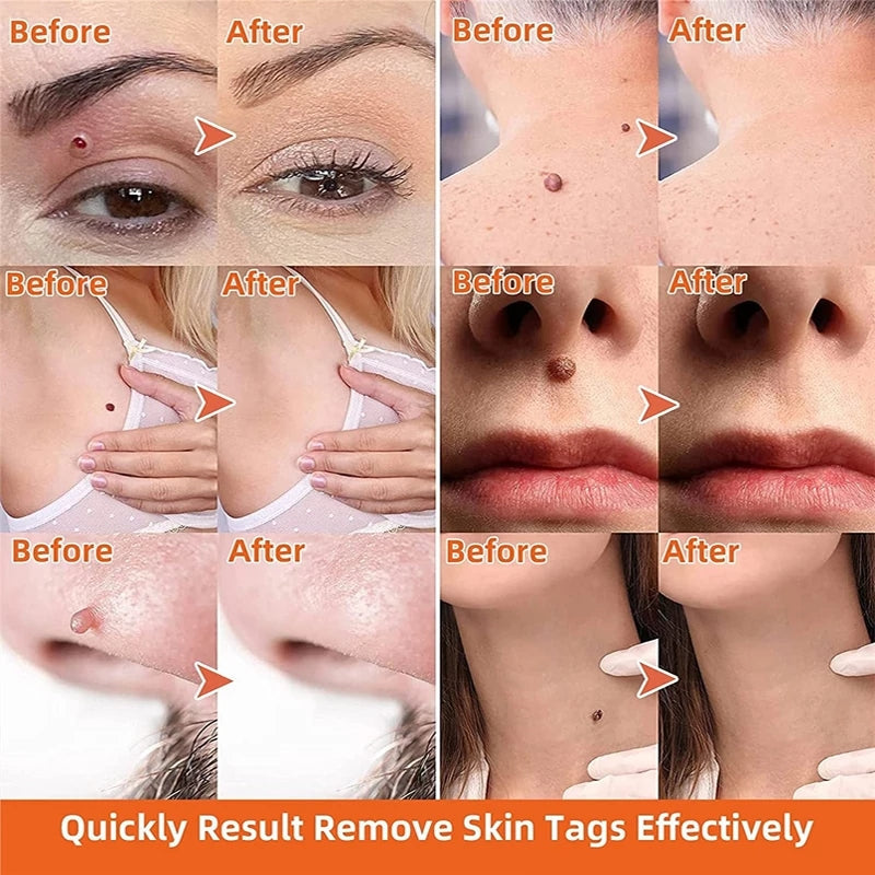 [🏆Official Flagship Store] 🔥LOVILDS® Wart remover ointment（👩‍⚕️AAD Doctor's Recommendation）