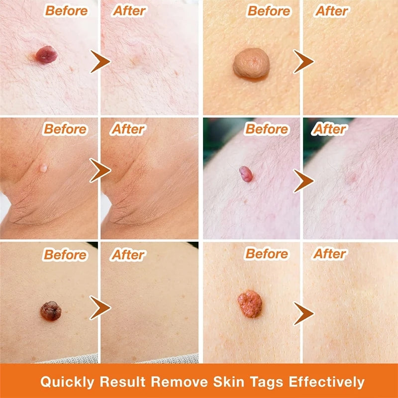 [🏆Official Flagship Store] 🔥LOVILDS® Wart remover ointment（👩‍⚕️AAD Doctor's Recommendation）