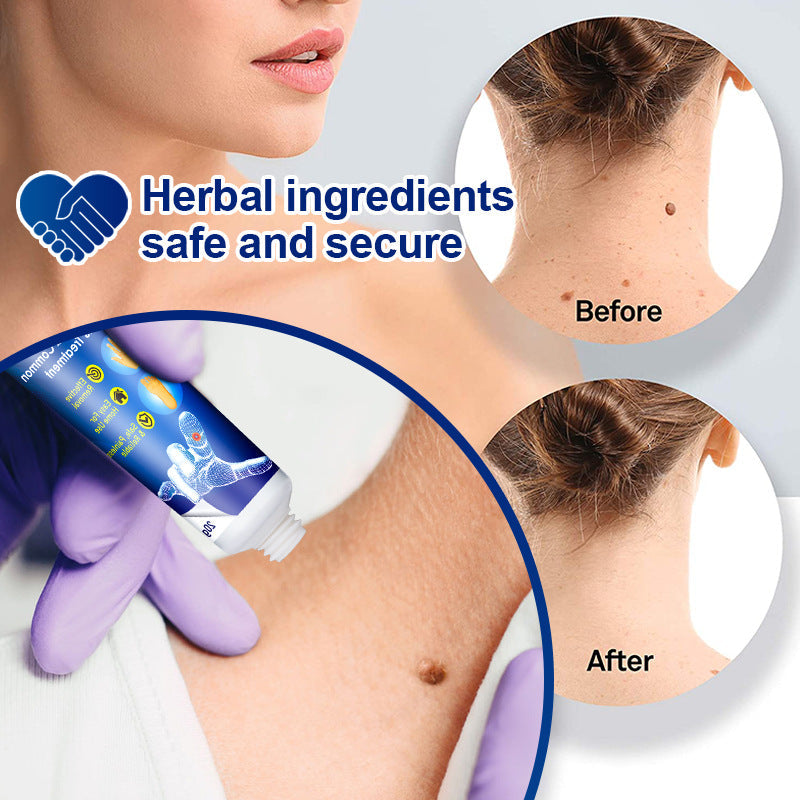 [🏆Official Flagship Store] 🔥LOVILDS® Wart remover ointment（👩‍⚕️AAD Doctor's Recommendation）